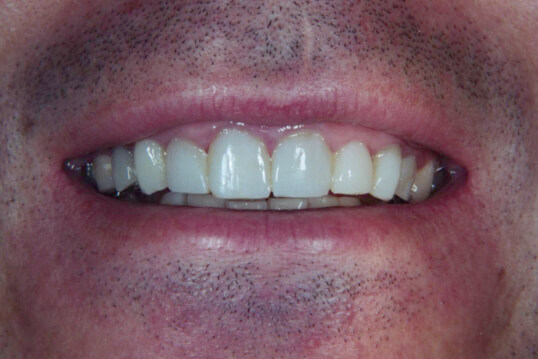 Composite Resin Crowns For Caries | Davis Dental