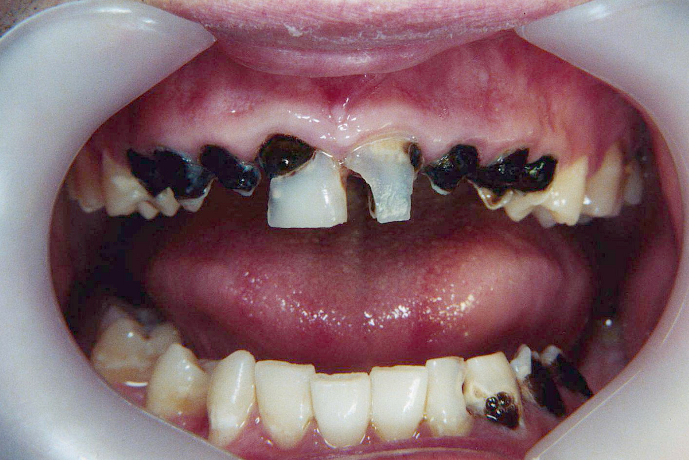 Composite resin crowns - Before
