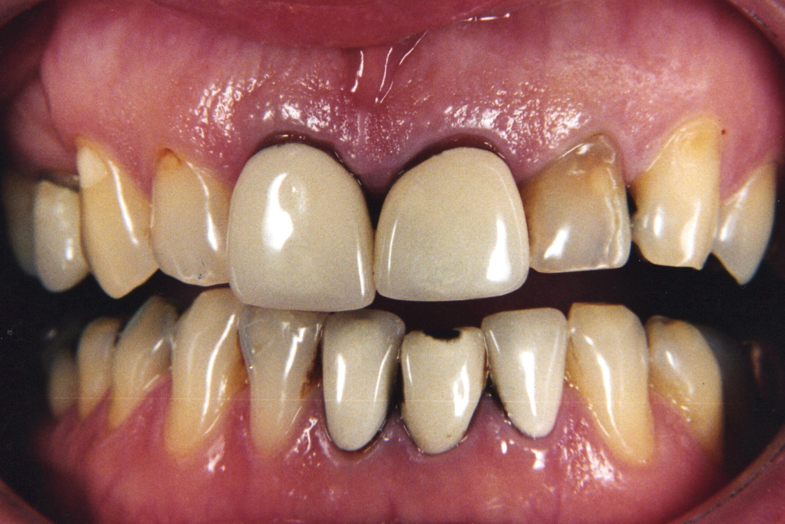 Crowns - Upper front teeth - Before